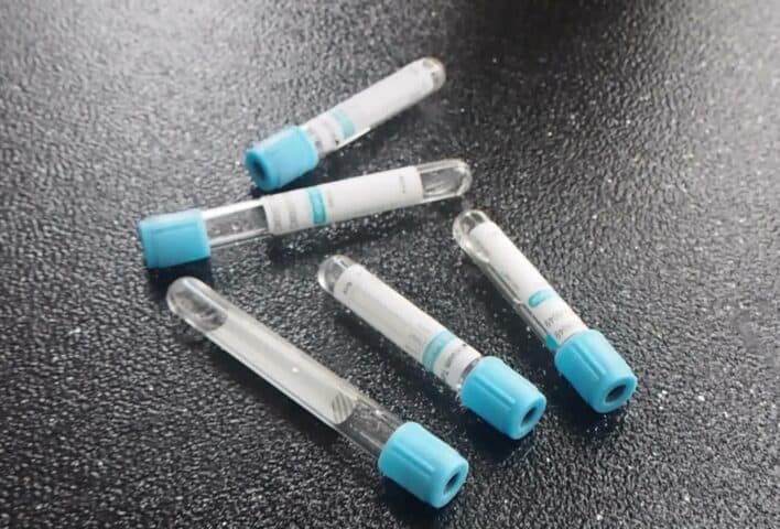 Sodyum Testi