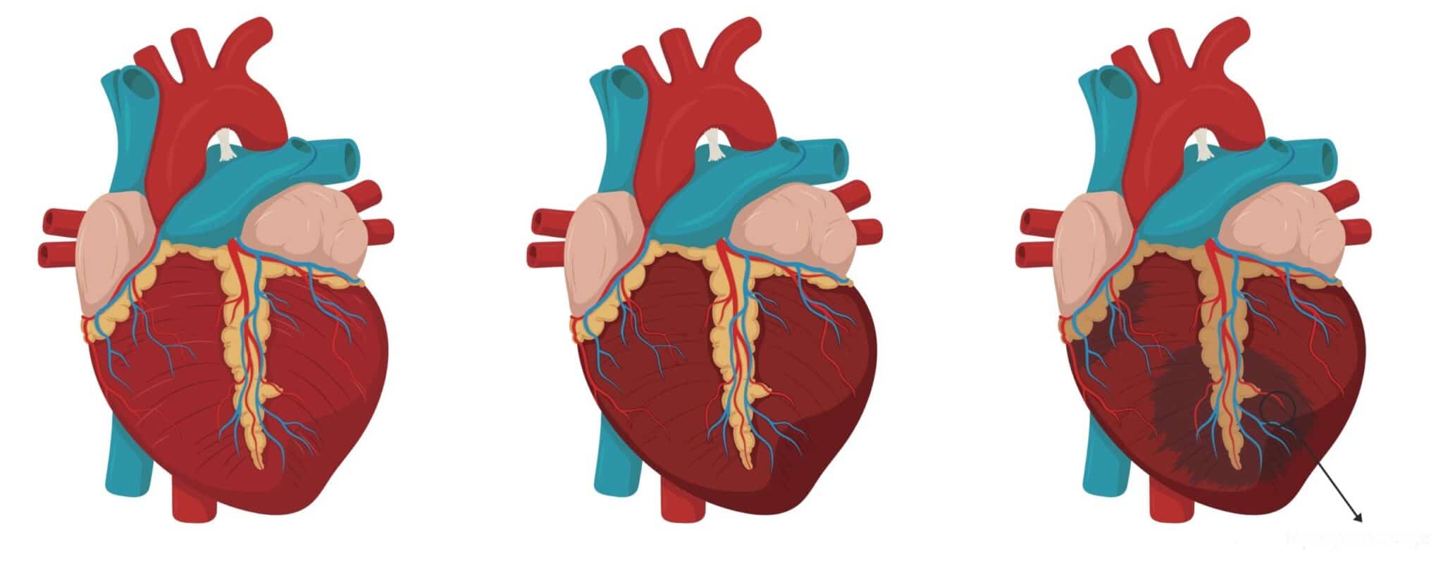 Kalp Yetersizliği Nasıl Teşhis Edilir? | Kalbinidinlesen