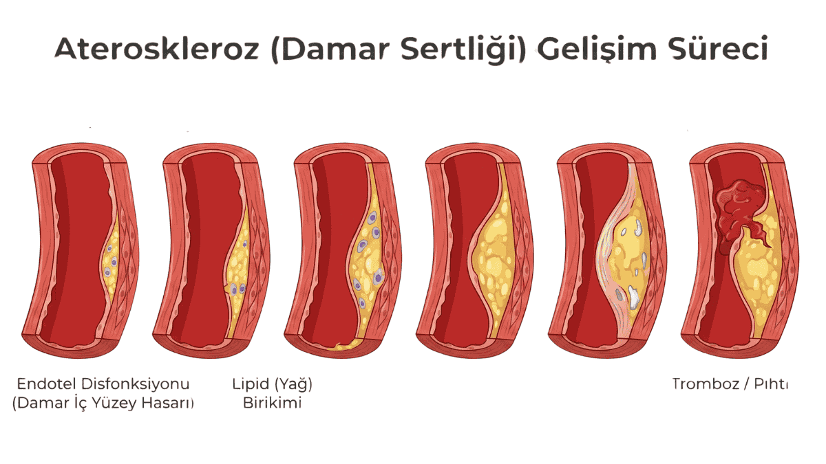 Damar içi plak oluşumu